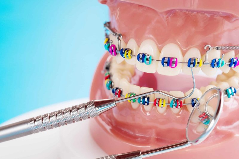 Metal Braces in San Antonio