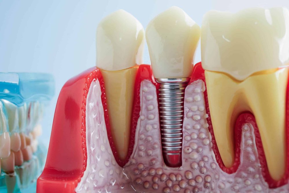Dental Implants San Antonio